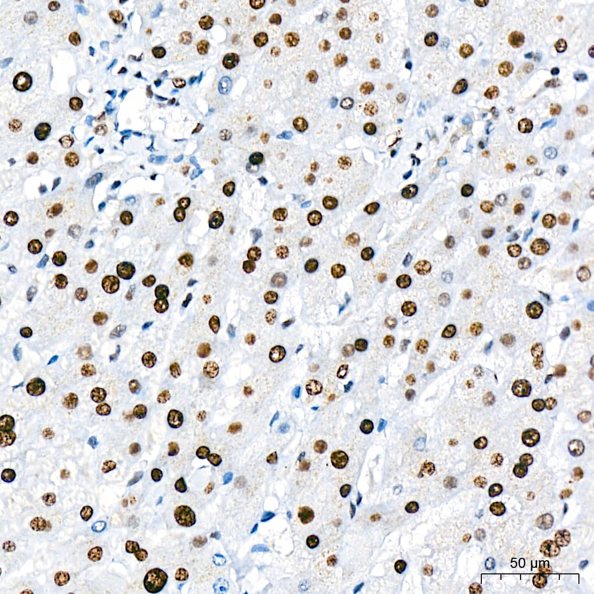 Immunohistochemistry: TRBP Antibody (9E6C9) [NBP3-16753] - Immunohistochemistry analysis of TRBP in paraffin-embedded human liver tissue using TRBP Rabbit mAb  at a dilution of 1:200 (40x lens). High pressure antigen retrieval was performed with 0.01 M citrate buffer (pH 6.0) prior to IHC staining.