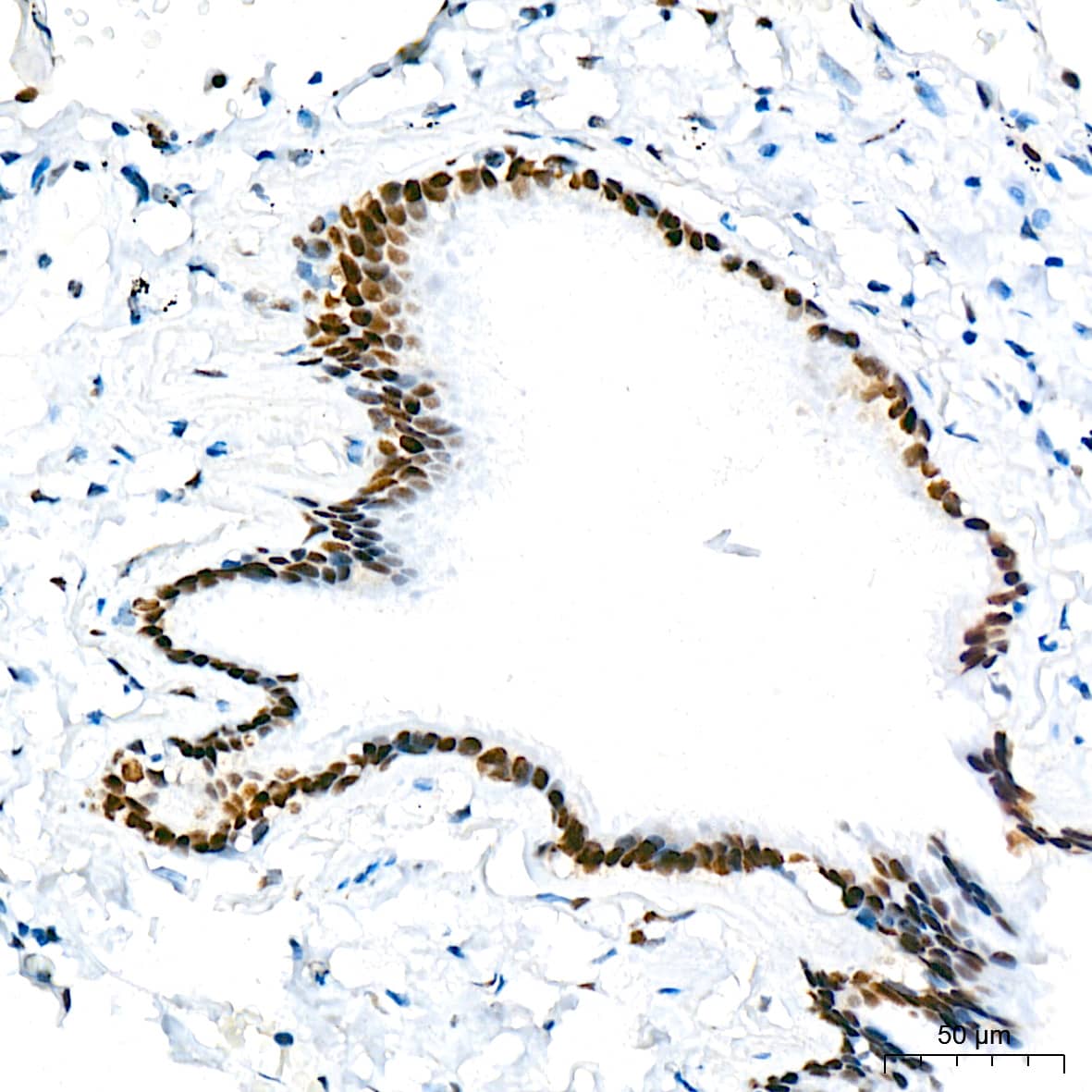 Immunohistochemistry: TRBP Antibody (9E6C9) [NBP3-16753] - Immunohistochemistry analysis of TRBP in paraffin-embedded human lung tissue using TRBP Rabbit mAb  at a dilution of 1:200 (40x lens). High pressure antigen retrieval was performed with 0.01 M citrate buffer (pH 6.0) prior to IHC staining.