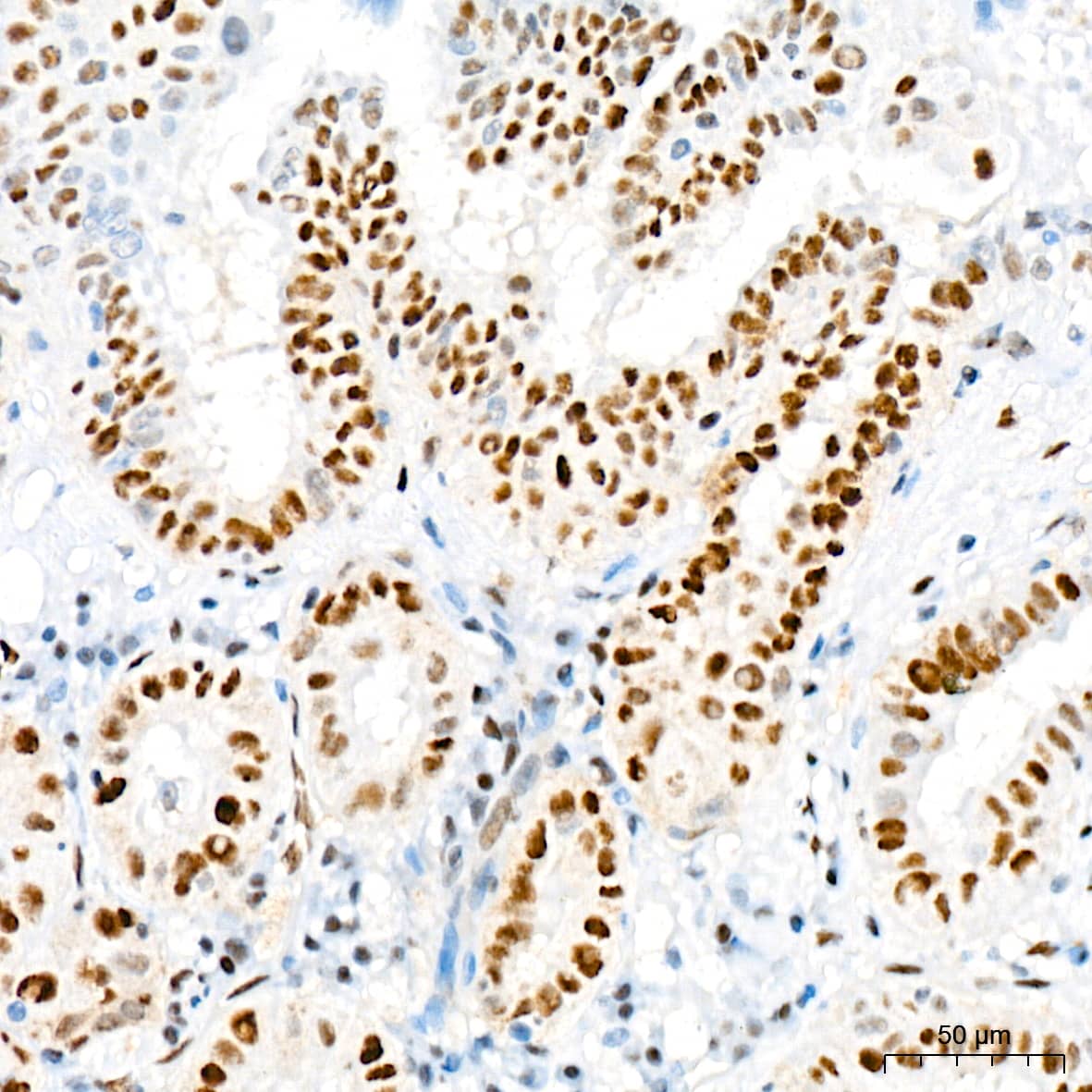 Immunohistochemistry: TRBP Antibody (9E6C9) [NBP3-16753] - Immunohistochemistry analysis of TRBP in paraffin-embedded human thyroid cancer tissue using TRBP Rabbit mAb  at a dilution of 1:200 (40x lens). High pressure antigen retrieval was performed with 0.01 M citrate buffer (pH 6.0) prior to IHC staining.