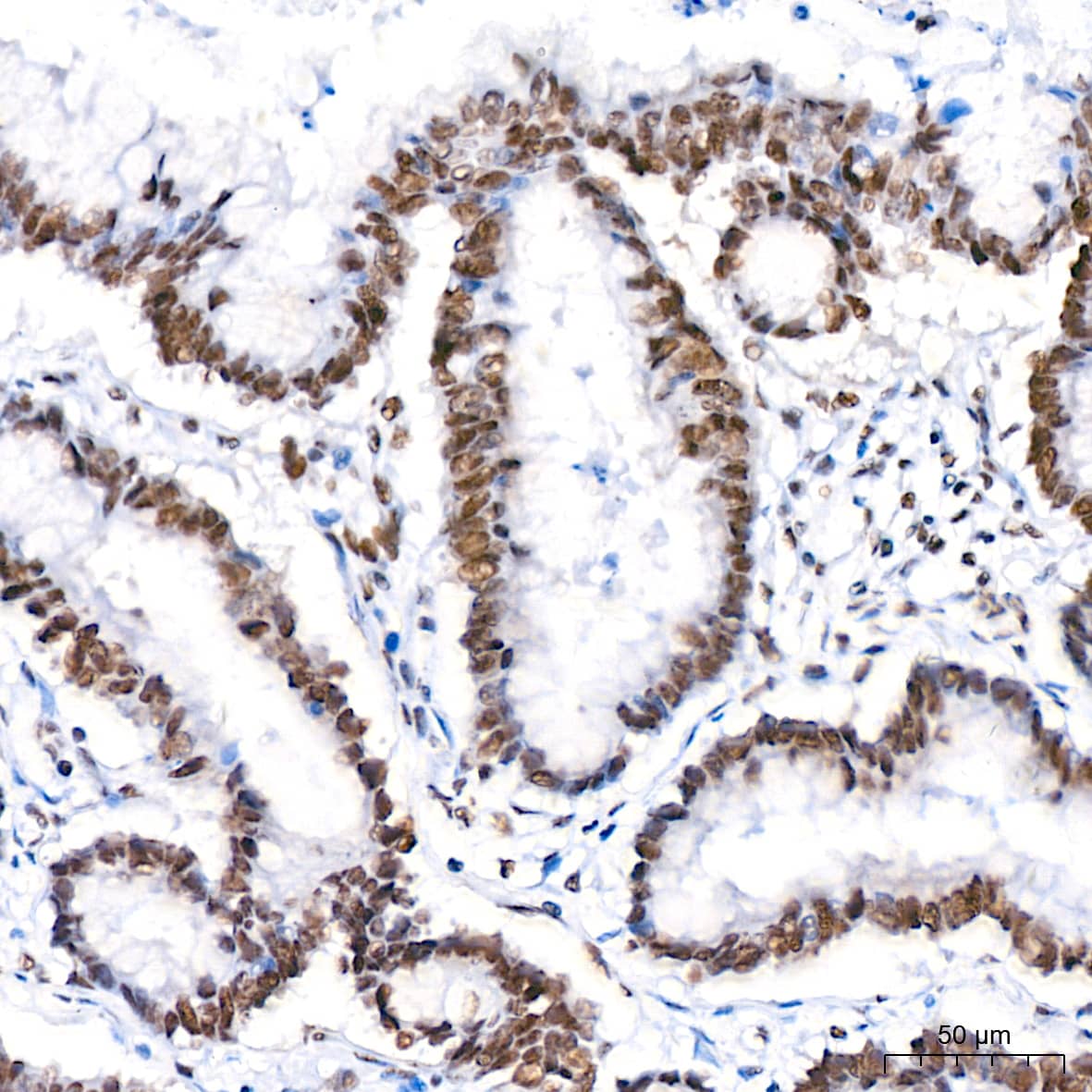 Immunohistochemistry: PTBP2 Antibody (10S9P6) [NBP3-16756] - Immunohistochemistry analysis of paraffin-embedded Human colon carcinoma tissue using PTBP2 Rabbit mAb at a dilution of 1:800 (40x lens). High pressure antigen retrieval performed with 0.01M Tris-EDTA Buffer (pH 9.0) prior to IHC staining.