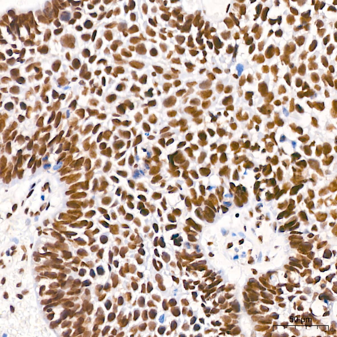 Immunohistochemistry: PTBP2 Antibody (10S9P6) [NBP3-16756] - Immunohistochemistry analysis of paraffin-embedded Human cervix cancer tissue using PTBP2 Rabbit mAb at a dilution of 1:800 (40x lens). High pressure antigen retrieval performed with 0.01M Tris-EDTA Buffer (pH 9.0) prior to IHC staining.