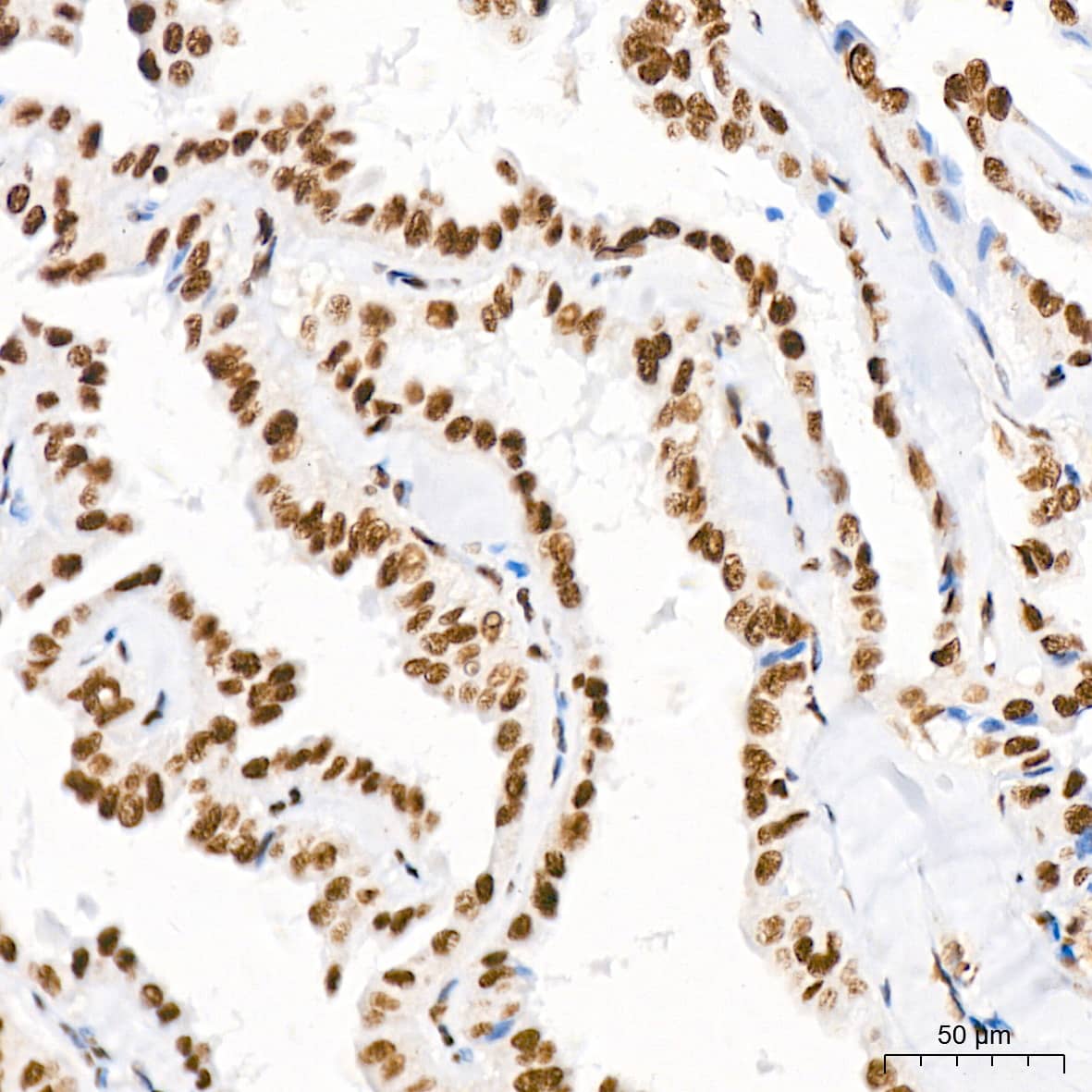 Immunohistochemistry: PTBP2 Antibody (10S9P6) [NBP3-16756] - Immunohistochemistry analysis of paraffin-embedded Human thyroid cancer tissue using PTBP2 Rabbit mAb at a dilution of 1:800 (40x lens). High pressure antigen retrieval performed with 0.01M Tris-EDTA Buffer (pH 9.0) prior to IHC staining.