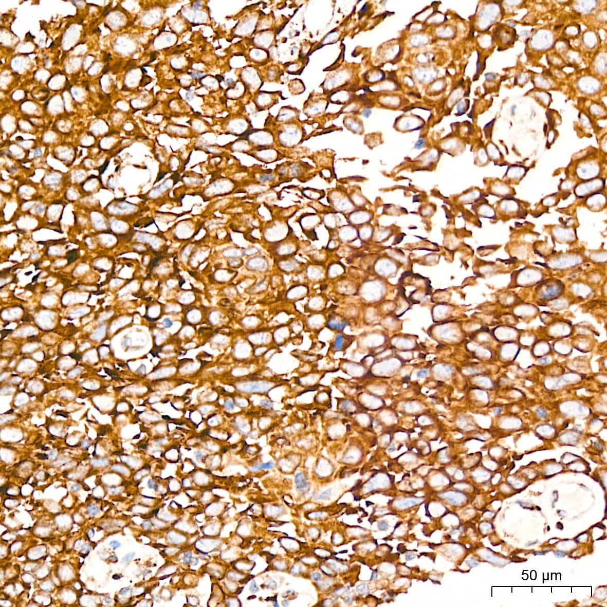 Immunohistochemistry: Peroxiredoxin 4 Antibody (9E7V0) [NBP3-16760] - Immunohistochemistry analysis of Peroxiredoxin 4 in paraffin-embedded human cervix cancer tissue using Peroxiredoxin 4 Rabbit mAb  at a dilution of 1:200 (40x lens). High pressure antigen retrieval was performed with 0.01 M citrate buffer (pH 6.0) prior to IHC staining.