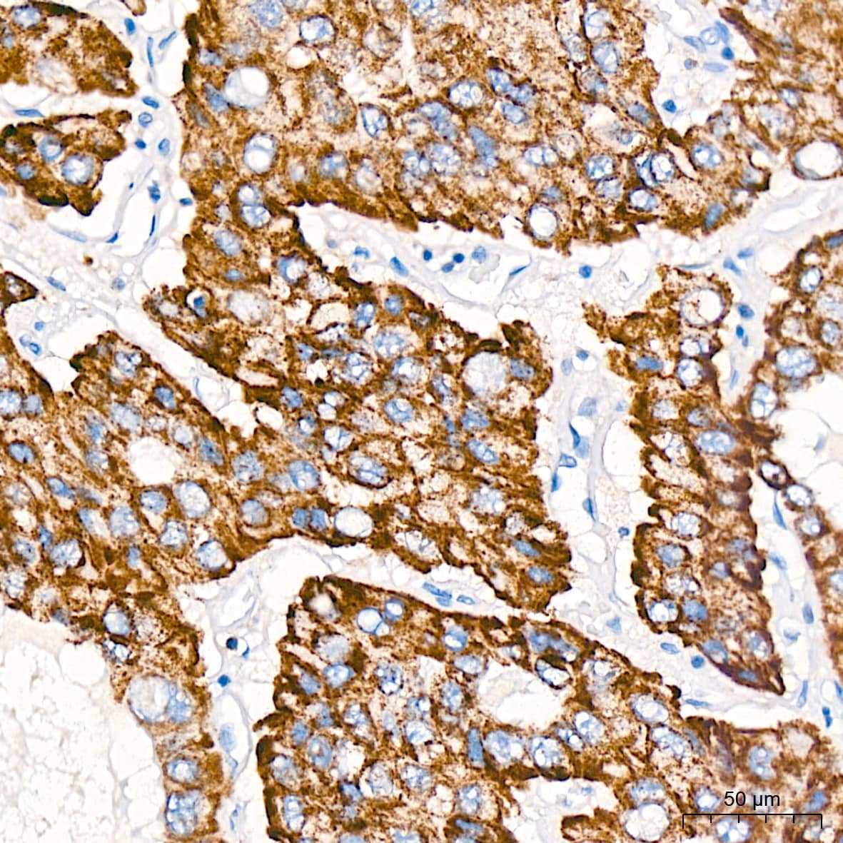 Immunohistochemistry: ABAT Antibody (10V1K9) [NBP3-16767] - Immunohistochemistry analysis of paraffin-embedded Human liver cancer tissue using GABA transaminase Rabbit mAb at a dilution of 1:200 (40x lens). High pressure antigen retrieval was performed with 0.01 M citrate buffer (pH 6.0) prior to IHC staining.