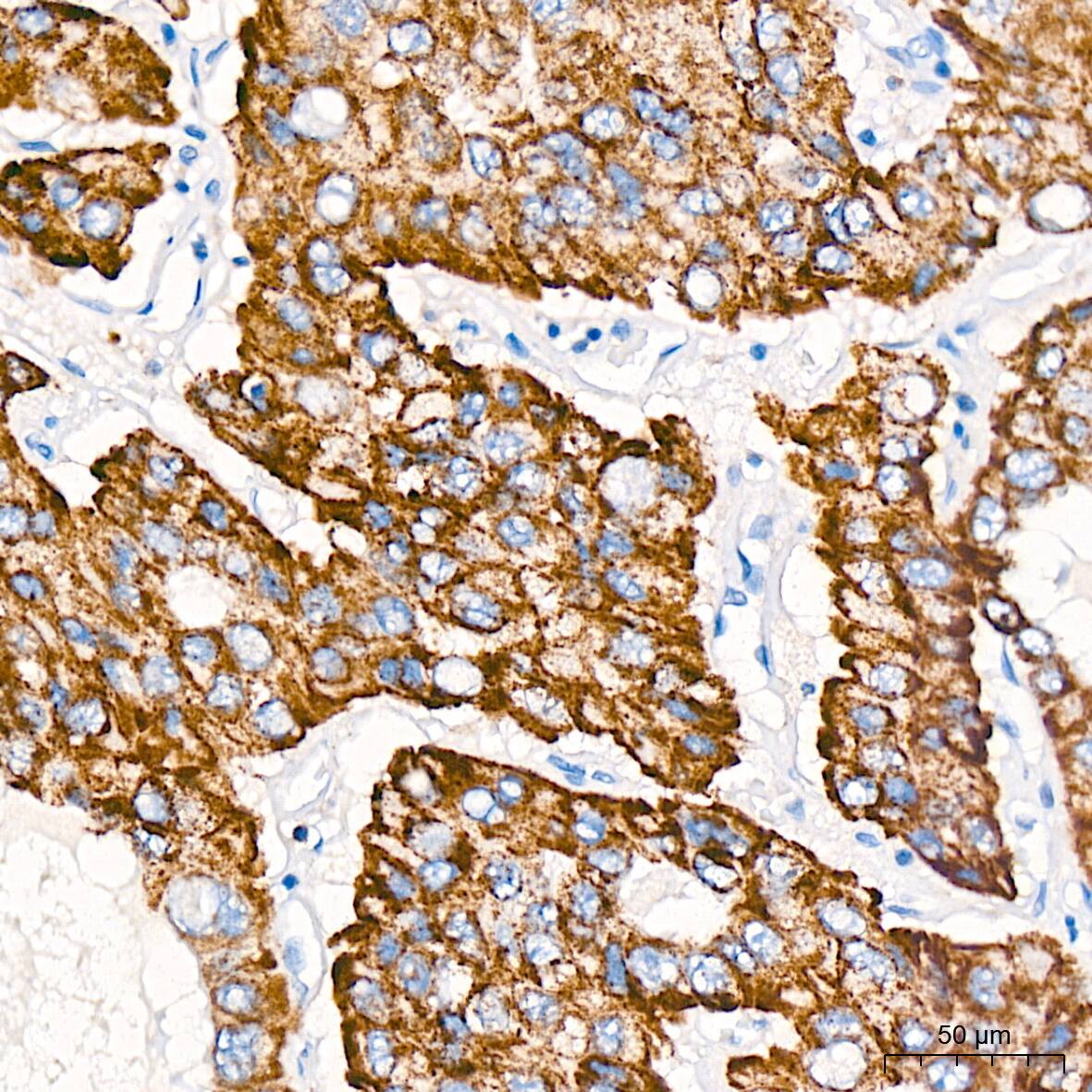 Immunohistochemistry: ABAT Antibody (10V1K9) [ABAT] - Immunohistochemistry analysis of paraffin-embedded Human liver cancer tissue using ABAT Rabbit mAb  at a dilution of 1:200 (40x lens). High pressure antigen retrieval was performed with 0.01 M citrate buffer (pH 6.0) prior to IHC staining.