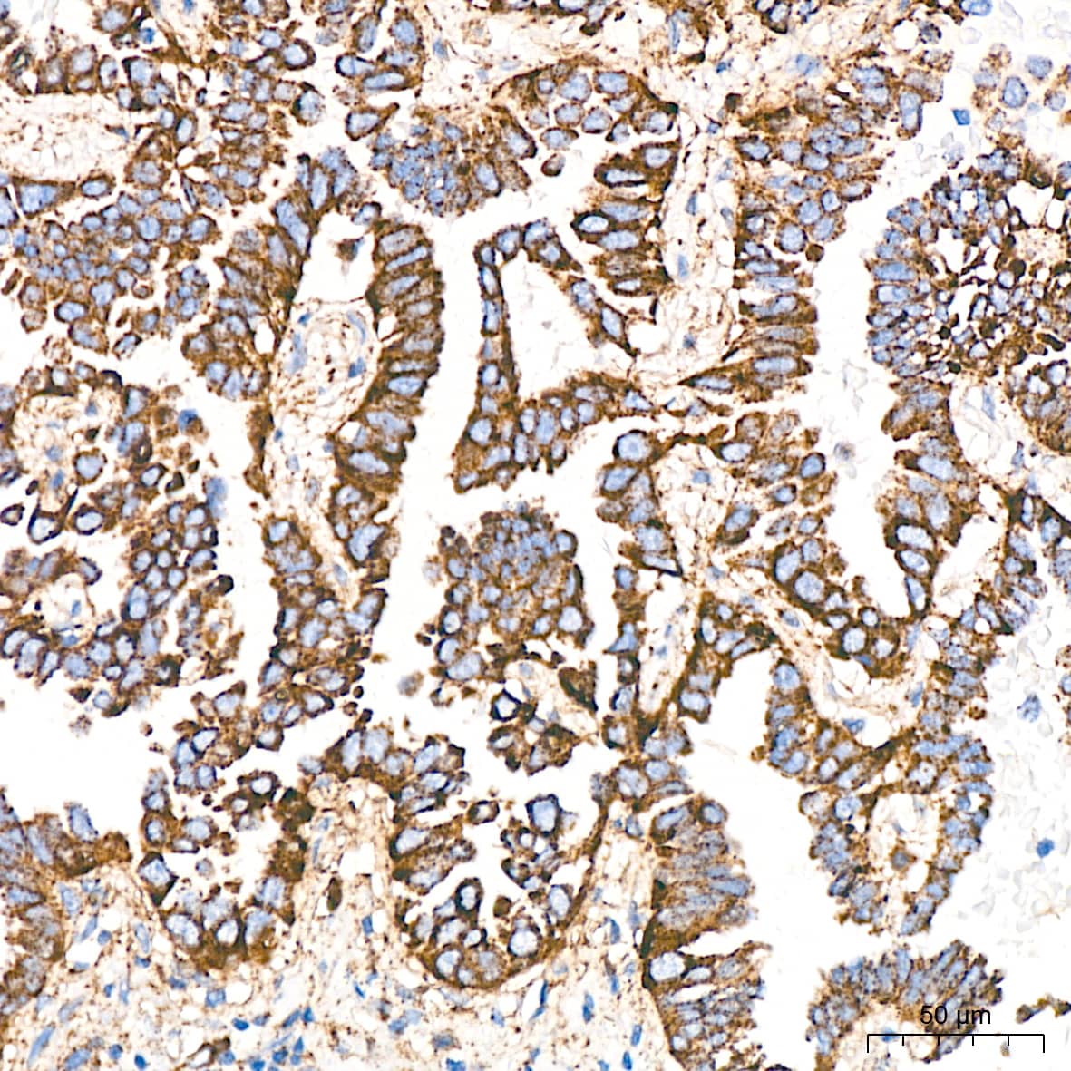 Immunohistochemistry: LIMPII/SR-B2 Antibody (7D2P5) [NBP3-16779] - Immunohistochemistry analysis of LIMPII/SR-B2 in paraffin-embedded Human lung adenocarcinoma tissue using LIMPII/SR-B2 Rabbit mAb  at a dilution of 1:1000 (40x lens).High pressure antigen retrieval was performed with 0.01 M citrate buffer (pH 6.0) prior to IHC staining.