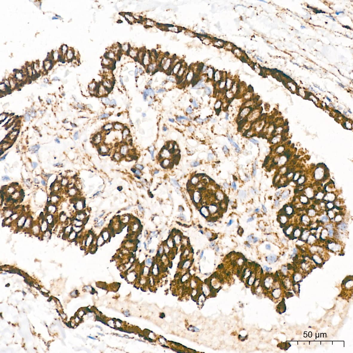 Immunohistochemistry: LIMPII/SR-B2 Antibody (7D2P5) [NBP3-16779] - Immunohistochemistry analysis of LIMPII/SR-B2 in paraffin-embedded human thyroid cancer tissue using LIMPII/SR-B2 Rabbit mAb  at a dilution of 1:1000 (40x lens).High pressure antigen retrieval was performed with 0.01 M citrate buffer (pH 6.0) prior to IHC staining.