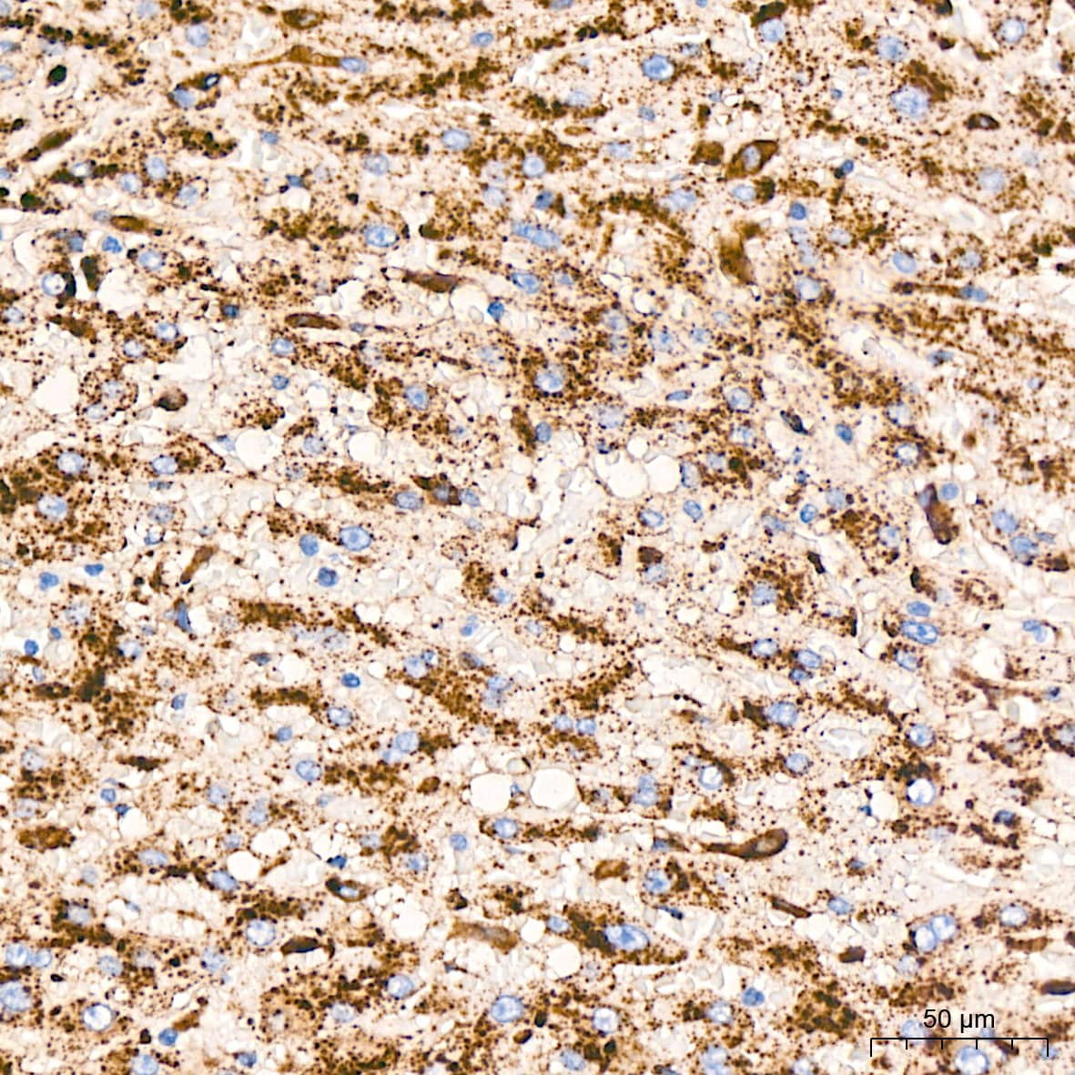 Immunohistochemistry: LIMPII/SR-B2 Antibody (7D2P5) [NBP3-16779] - Immunohistochemistry analysis of LIMPII/SR-B2 in paraffin-embedded human liver tissue using LIMPII/SR-B2 Rabbit mAb  at a dilution of 1:1000 (40x lens).High pressure antigen retrieval was performed with 0.01 M citrate buffer (pH 6.0) prior to IHC staining.