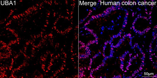 Immunocytochemistry/ Immunofluorescence: Ubiquitin-activating Enzyme/UBE1 Antibody (6H2I9) [NBP3-16792] - Confocal imaging of paraffin-embedded Human colon cancer tissue using Ubiquitin-activating Enzyme/UBE1 Rabbit mAb followed by a further incubation with Cy3 Goat Anti-Rabbit IgG (H+L) . DAPI was used for nuclear staining (Blue). Objective: 40x. Perform high pressure antigen retrieval with 0.01 M citrate buffer (pH 6.0) prior to IF staining.