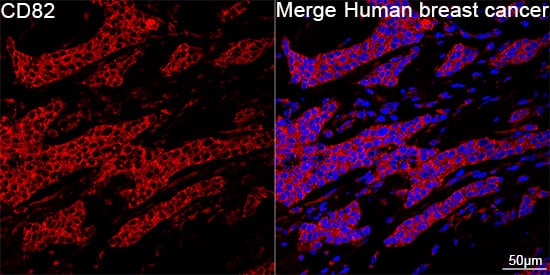 Immunocytochemistry/ Immunofluorescence: CD82/Kai-1 Antibody (0T3L6) [NBP3-16797] - Confocal imaging of paraffin-embedded Human breast cancer using CD82/Kai-1 Rabbit mAb followed by a further incubation with Cy3 Goat Anti-Rabbit IgG (H+L) . DAPI was used for nuclear staining (Blue). Objective: 40x. Perform high pressure antigen retrieval with 0.01 M citrate buffer (pH 6.0) prior to IF staining.