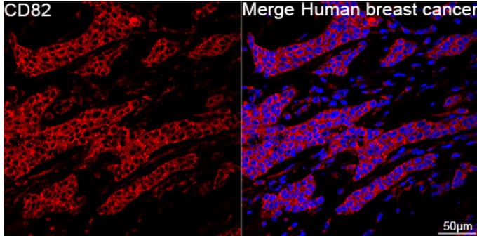 Immunocytochemistry/Immunofluorescence: CD82/Kai-1 Antibody (0T3L6) [NBP3-16797] - Confocal imaging of paraffin-embedded Human breast cancer using CD82 Rabbit mAb (dilution 1:200) followed by a further incubation with Cy3 Goat Anti-Rabbit IgG (H+L) (dilution 1:500) (Red). DAPI was used for nuclear staining (Blue). Objective: 40x. Perform high pressure antigen retrieval with 0.01 M citrate buffer (pH 6.0) prior to IF staining.