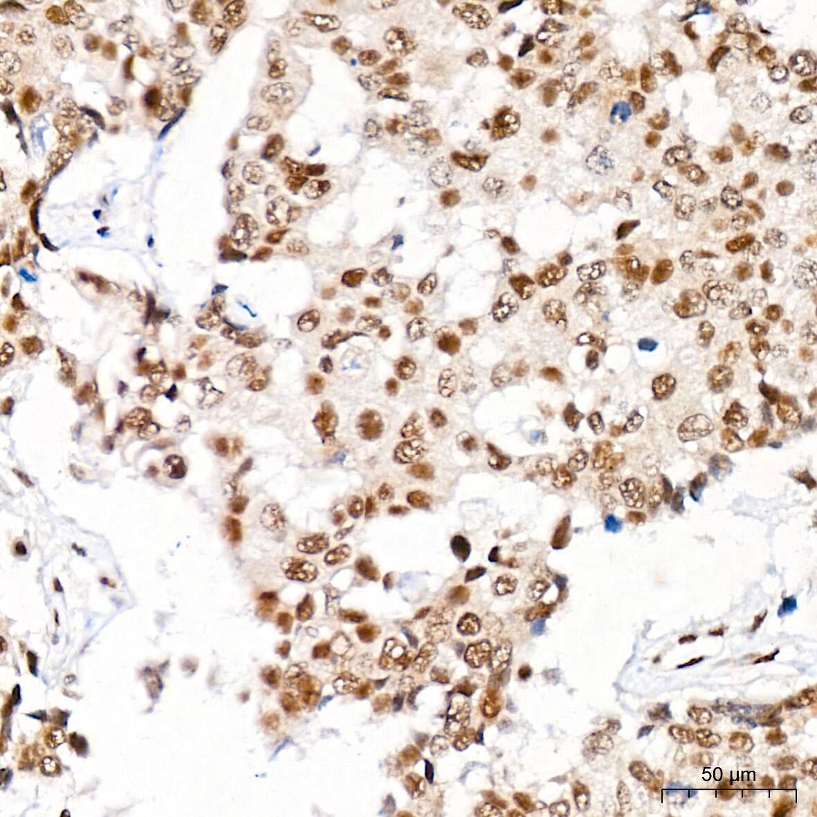 Immunohistochemistry: CaMKIV Antibody (1G4P4) [NBP3-16802] - Immunohistochemistry analysis of CaMKIV in paraffin-embedded human breast cancer tissue using CaMKIV Rabbit mAb  at a dilution of 1:800 (40x lens). High pressure antigen retrieval was performed with 0.01 M citrate buffer (pH 6.0) prior to IHC staining.