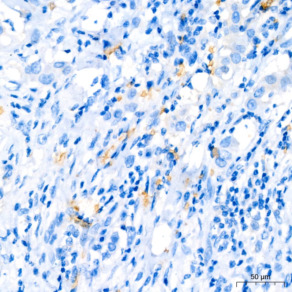 Immunohistochemistry: Hemoglobin A1 Antibody (1R1N7) [NBP3-16804] - Immunohistochemistry analysis of paraffin-embedded Human breast cancer tissue using Hemoglobin A1 Rabbit mAb at a dilution of 1:200 (40x lens). High pressure antigen retrieval performed with 0.01M Citrate Buffer (pH 6.0) prior to IHC staining.