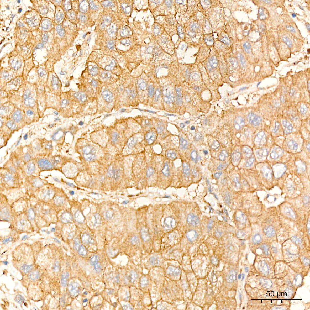 Immunohistochemistry: IL-11R alpha Antibody (10Z3S9) [NBP3-16809] - Immunohistochemistry analysis of IL-11R alpha in paraffin-embedded human liver cancer tissue using IL-11R alpha Rabbit mAb  at a dilution of 1:400 (40x lens).High pressure antigen retrieval was performed with 0.01 M citrate buffer (pH 6.0) prior to IHC staining.
