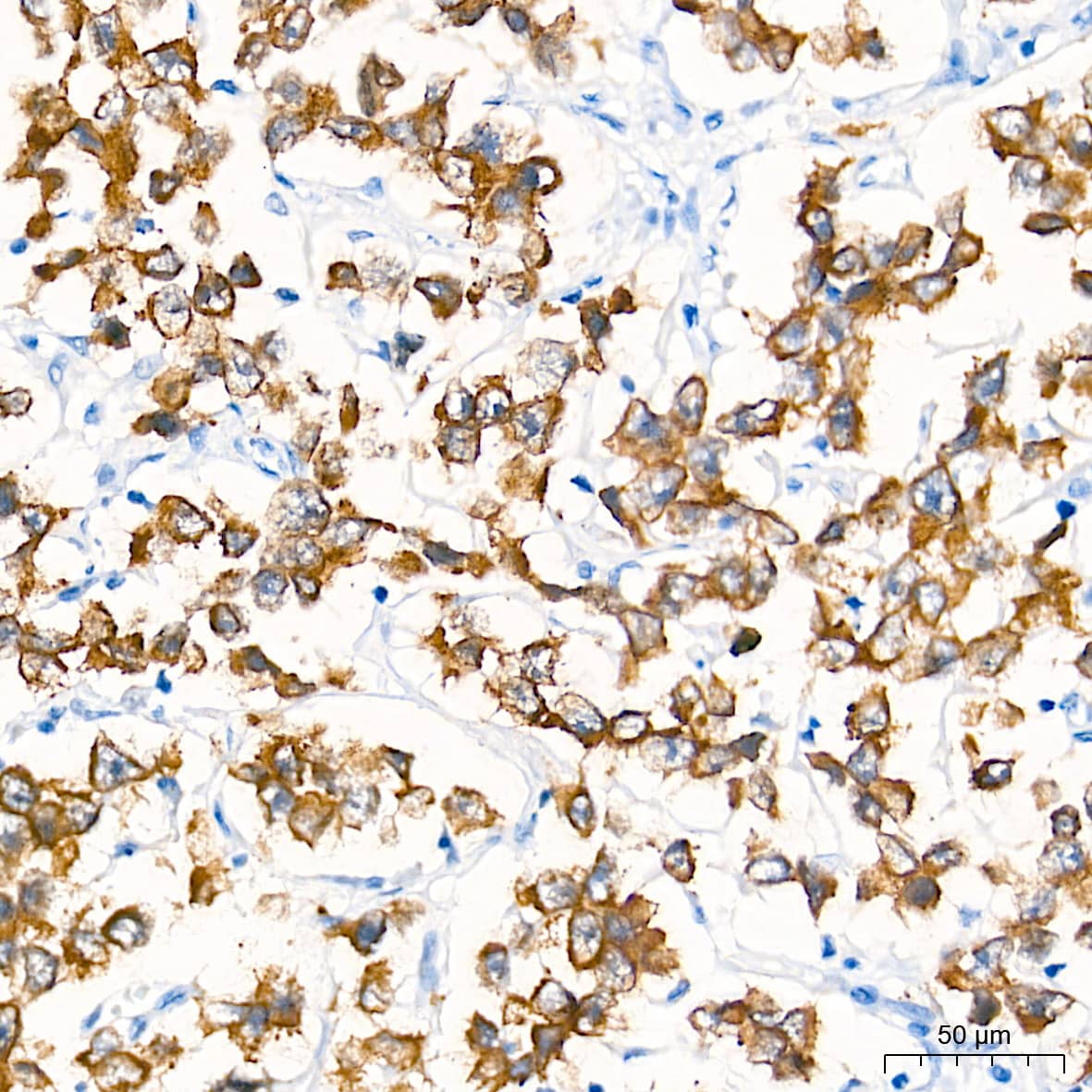 Immunohistochemistry: LIN-28B Antibody (7D7F7) [NBP3-16815] - Immunohistochemistry analysis of paraffin-embedded Human seminoma tissue using LIN-28B Rabbit mAb  at a dilution of 1:2000 (40x lens). High pressure antigen retrieval performed with 0.01M Tris-EDTA Buffer (pH 9.0) prior to IHC staining.