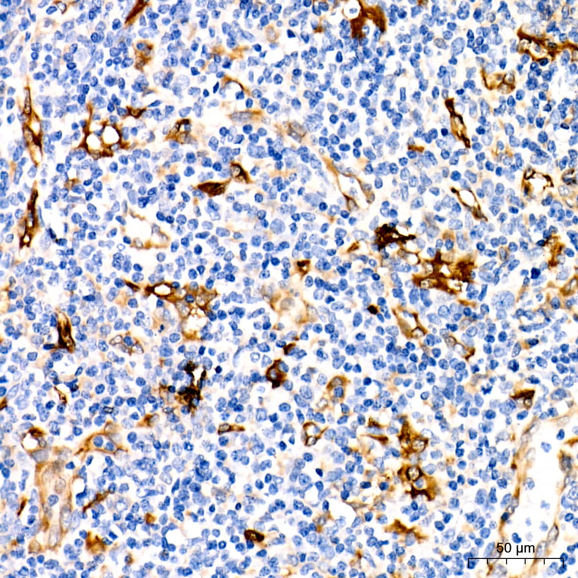 Immunohistochemistry: Fascin Antibody (1B3V6) [NBP3-16828] - Immunohistochemistry analysis of paraffin-embedded Human anaplastic large cell lymphoma using Fascin Rabbit mAb at dilution of 1:100 (40x lens). Microwave antigen retrieval performed with 0.01M Tris/EDTA Buffer (pH 9.0) prior to IHC staining.