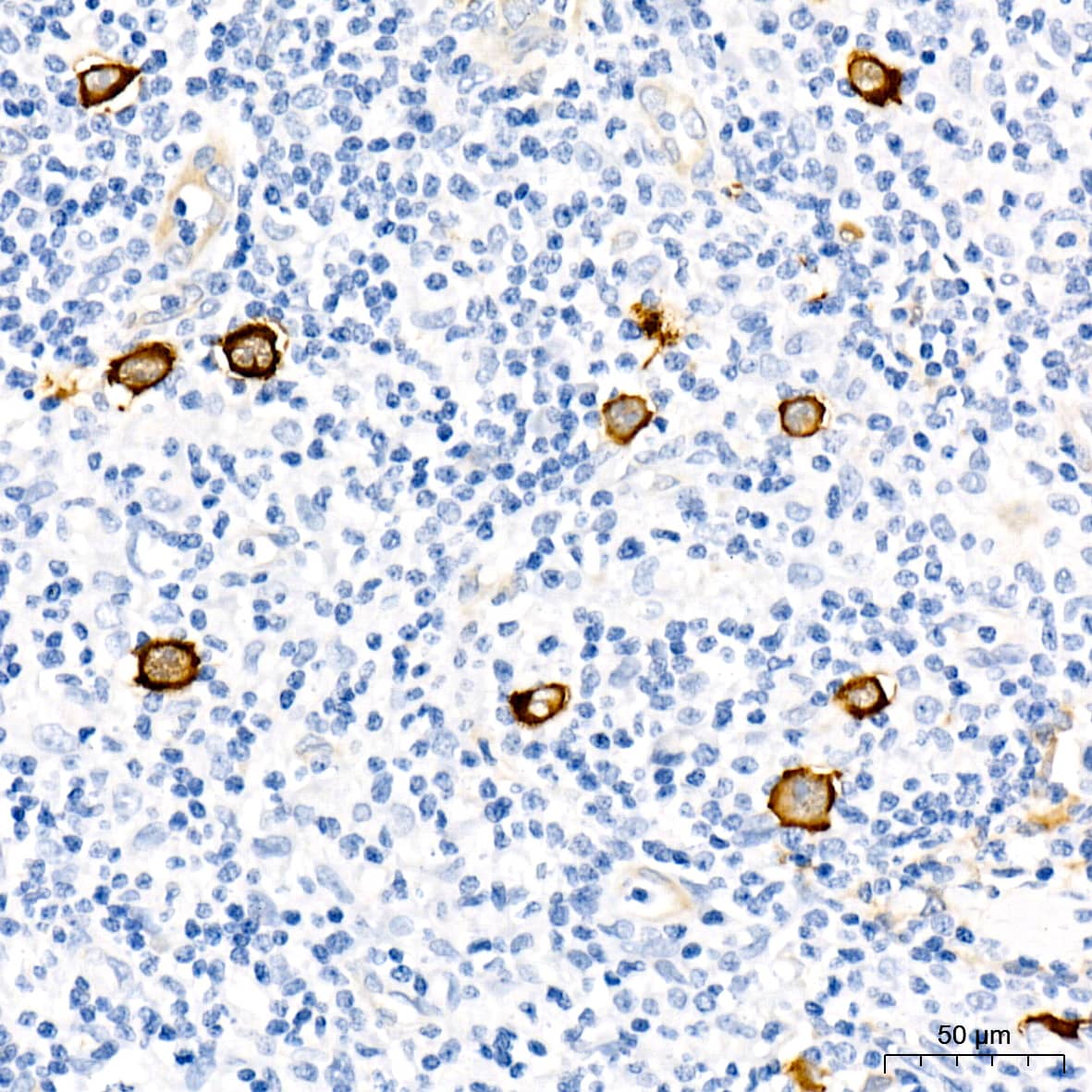 Immunohistochemistry: Fascin Antibody (1B3V6) [NBP3-16828] - Immunohistochemistry analysis of paraffin-embedded Human Hodgkin lymphoma using Fascin Rabbit mAb at dilution of 1:100 (40x lens). Microwave antigen retrieval performed with 0.01M Tris/EDTA Buffer (pH 9.0) prior to IHC staining.