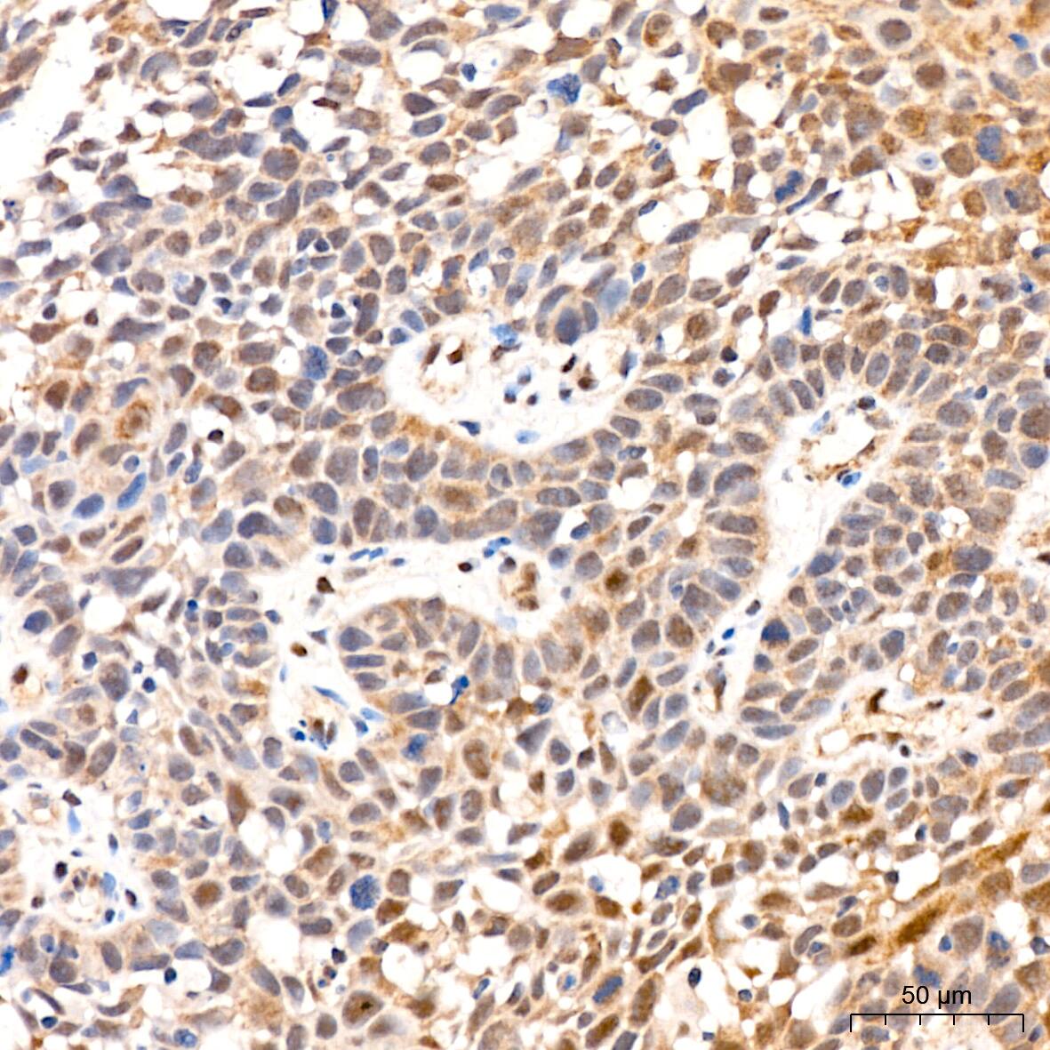 Immunohistochemistry: PSMD14 Antibody (5V0H3) [NBP3-16837] - Immunohistochemistry analysis of paraffin-embedded Human cervix cancer tissue using PSMD14 Rabbit mAb at a dilution of 1:200 (40x lens). High pressure antigen retrieval performed with 0.01M Citrate Bufferr (pH 6.0) prior to IHC staining.