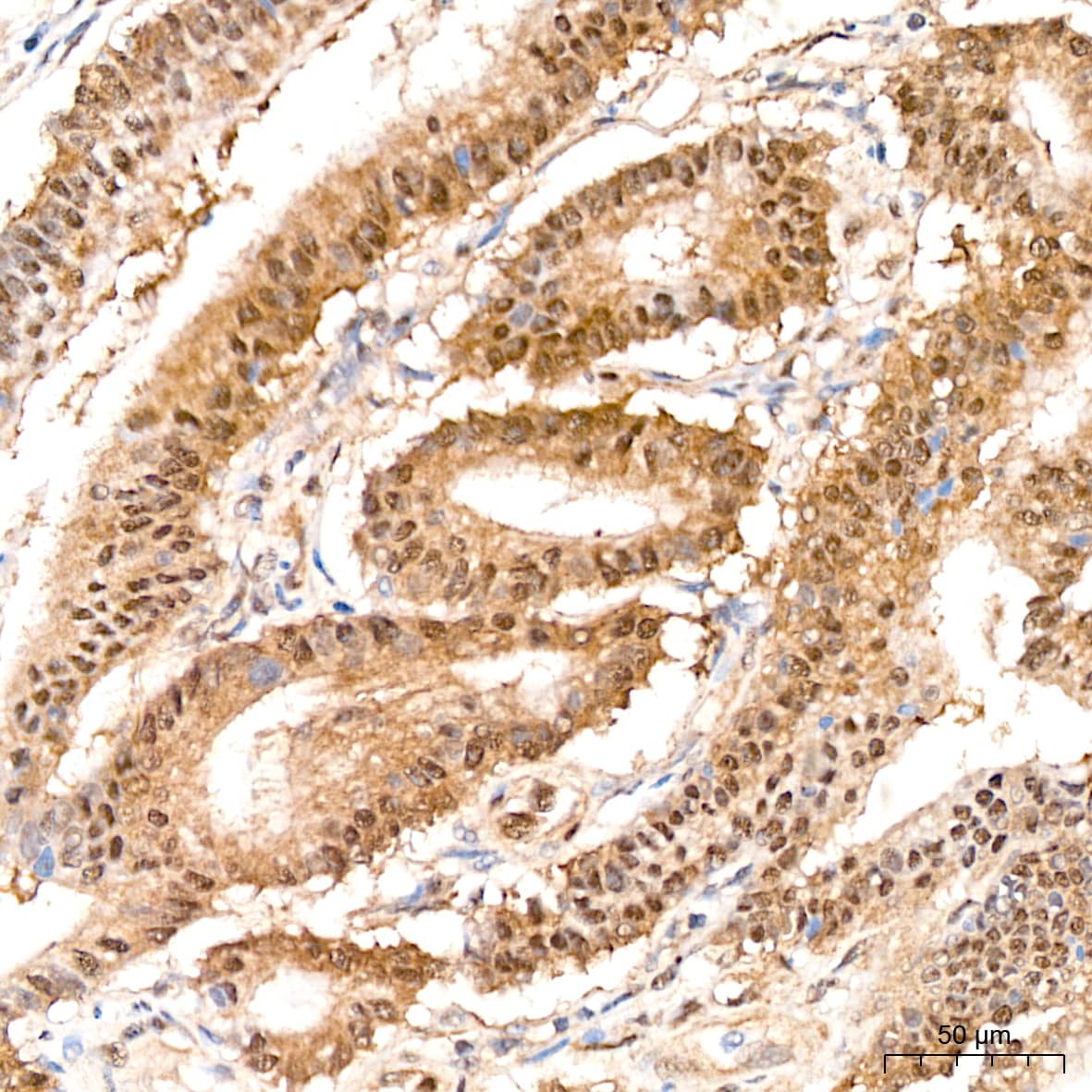 Immunohistochemistry: PSMD14 Antibody (5V0H3) [NBP3-16837] - Immunohistochemistry analysis of paraffin-embedded Human colon carcinoma tissue using PSMD14 Rabbit mAb at a dilution of 1:200 (40x lens). High pressure antigen retrieval performed with 0.01M Citrate Bufferr (pH 6.0) prior to IHC staining.