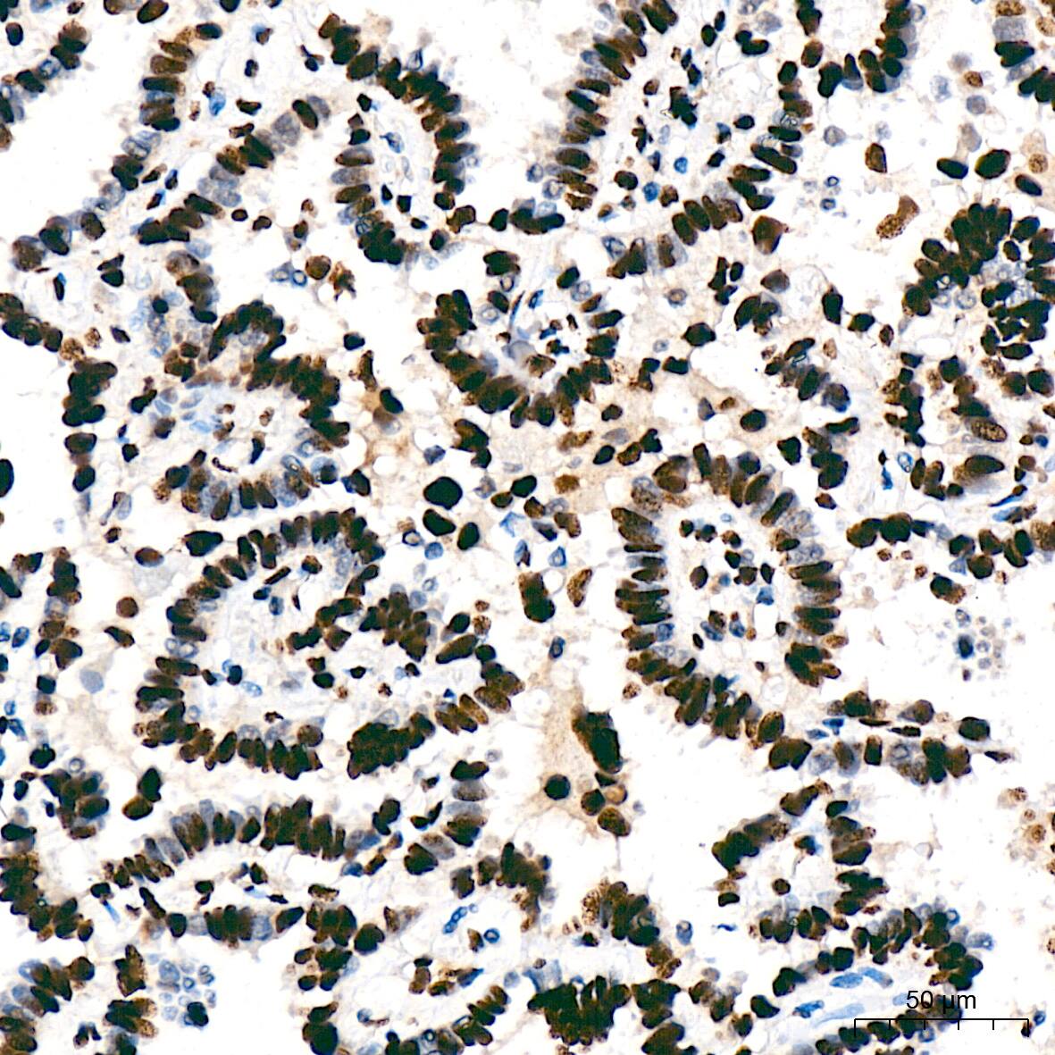 Immunohistochemistry: SAP130 Antibody (3K1X4) [NBP3-16842] - Immunohistochemistry analysis of SAP130 in paraffin-embedded Human lung adenocarcinoma tissue using SAP130 Rabbit mAb  at a dilution of 1:200 (40x lens). High pressure antigen retrieval was performed with 0.01 M citrate buffer (pH 6.0) prior to IHC staining.