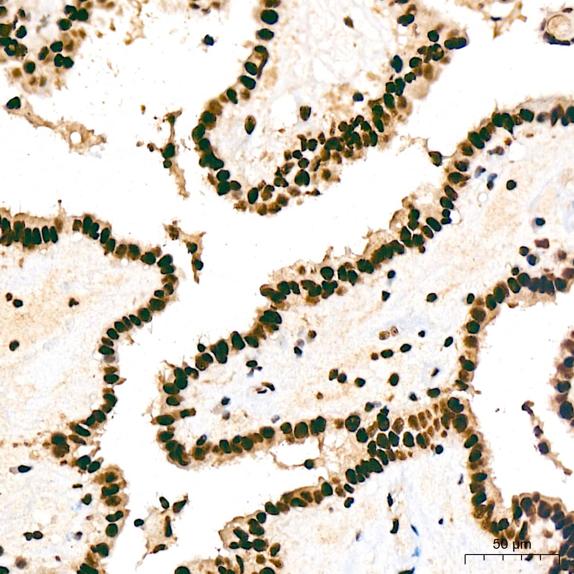 Immunohistochemistry: SAP130 Antibody (3K1X4) [NBP3-16842] - Immunohistochemistry analysis of SAP130 in paraffin-embedded human thyroid cancer tissue using SAP130 Rabbit mAb  at a dilution of 1:200 (40x lens). High pressure antigen retrieval was performed with 0.01 M citrate buffer (pH 6.0) prior to IHC staining.