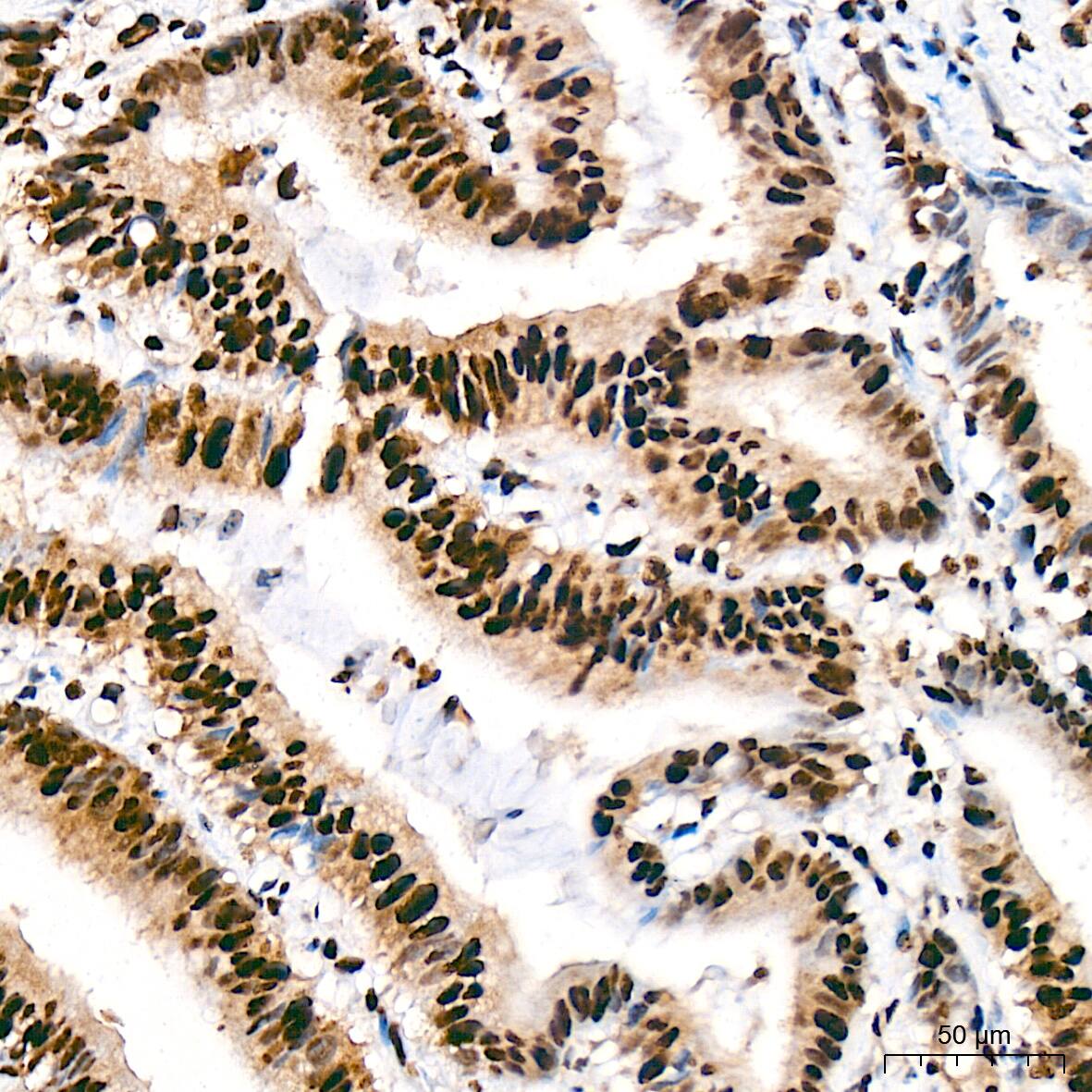 Immunohistochemistry: SAP130 Antibody (3K1X4) [NBP3-16842] - Immunohistochemistry analysis of SAP130 in paraffin-embedded human colon carcinoma tissue using SAP130 Rabbit mAb  at a dilution of 1:200 (40x lens). High pressure antigen retrieval was performed with 0.01 M citrate buffer (pH 6.0) prior to IHC staining.