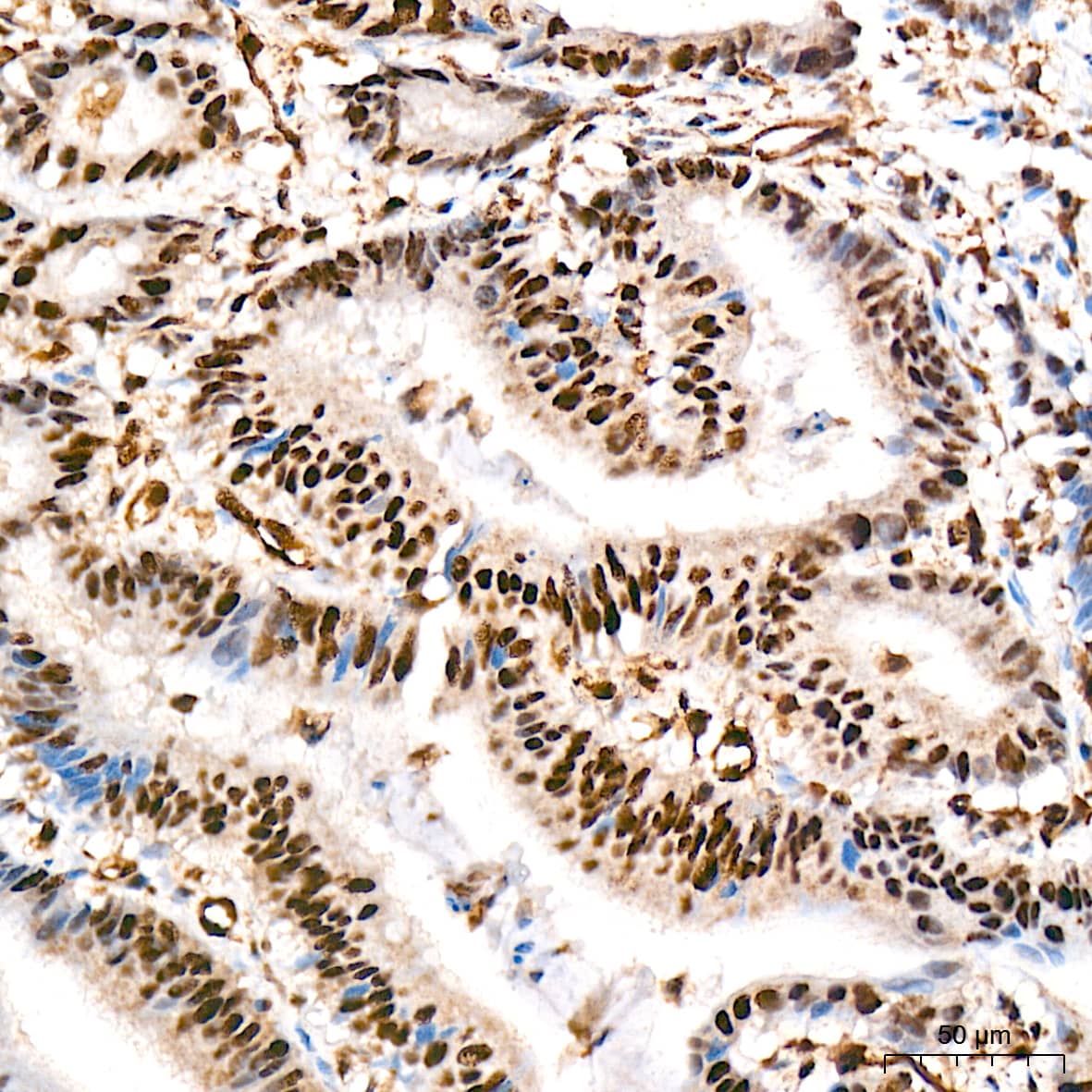 Immunohistochemistry: PRP19 Antibody (4M3Z1) [NBP3-16853] - Immunohistochemistry analysis of PRP19 in paraffin-embedded human colon carcinoma tissue using PRP19 Rabbit mAb  at a dilution of 1:200 (40x lens). High pressure antigen retrieval was performed with 0.01 M citrate buffer (pH 6.0) prior to IHC staining.