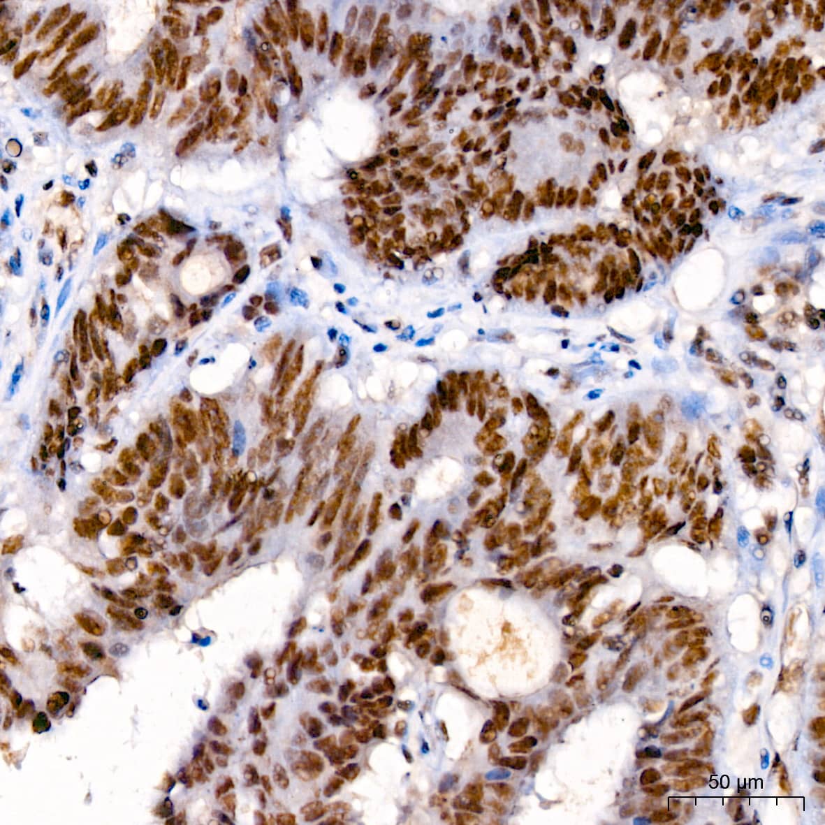 Immunohistochemistry: RNA Polymerase II/POLR2A [p Ser7] Antibody - Azide and BSA Free [NBP3-16906] - Immunohistochemistry analysis of paraffin-embedded Human colon carcinoma using RNA Polymerase II/POLR2A Rabbit pAb at dilution of 1:200 (40x lens). High pressure antigen retrieval performed with 0.01M Citrate Bufferr (pH 6.0) prior to IHC staining.