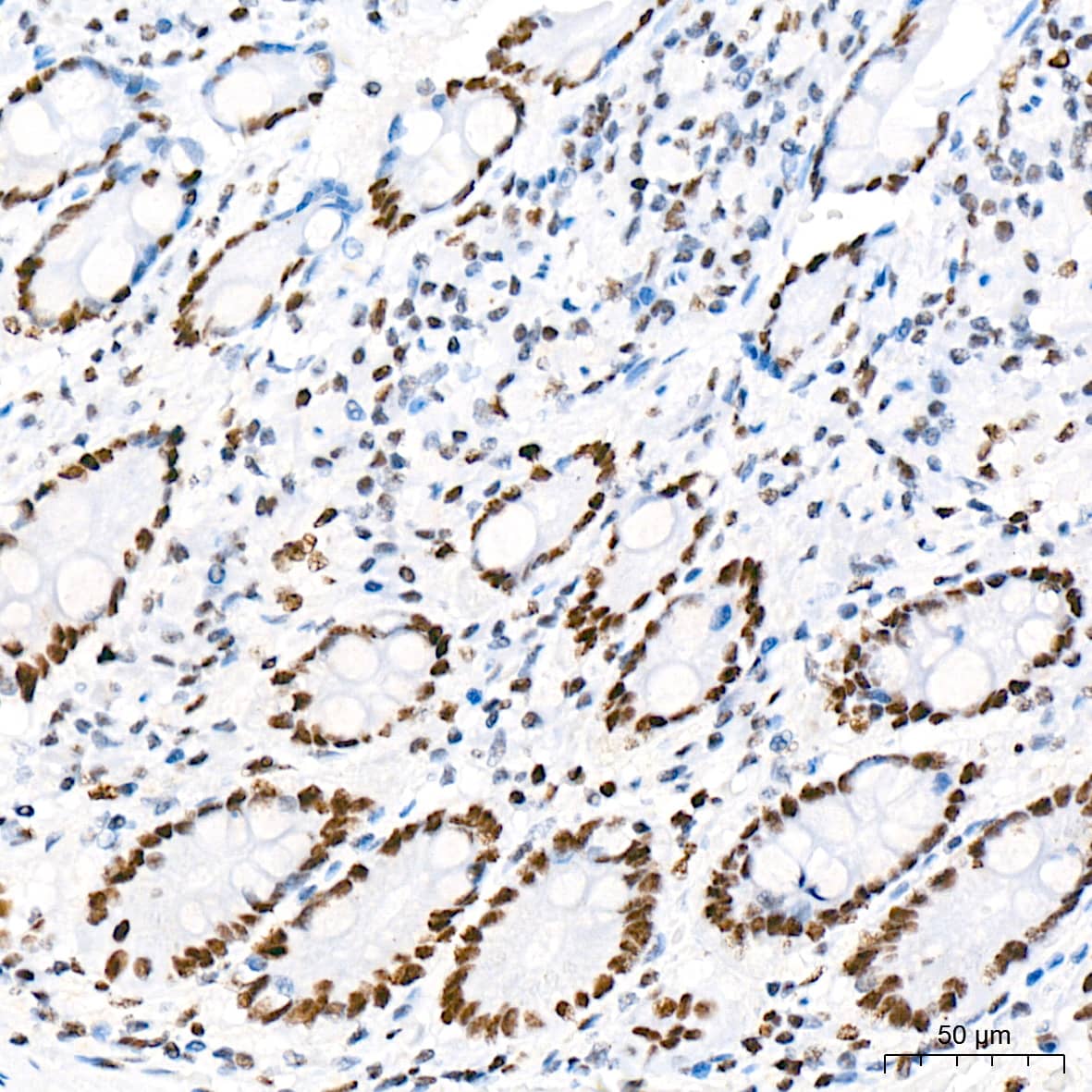 Immunohistochemistry: RNA Polymerase II/POLR2A [p Ser5] Antibody (10C7U2) [NBP3-16910] - Immunohistochemistry analysis of paraffin-embedded Human colon tissue using RNA Polymerase II/POLR2A Rabbit mAb at a dilution of 1:200 (40x lens). High pressure antigen retrieval was performed with 0.01 M citrate buffer (pH 6.0) prior to IHC staining.