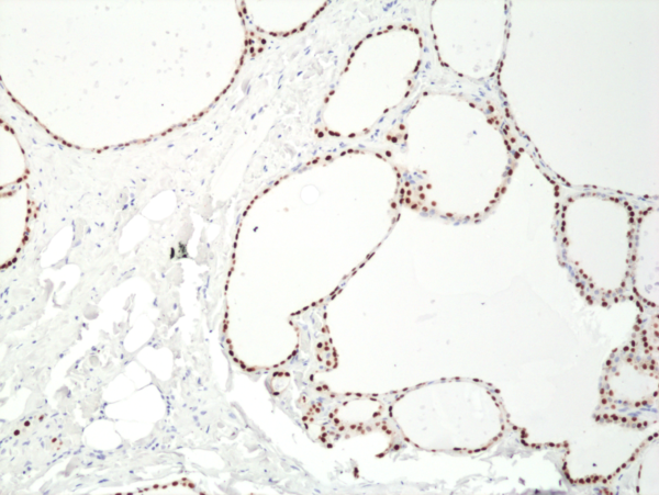 Immunohistochemistry-Paraffin: PAX8 Antibody (RM436) [NBP3-18831] - Immunohistochemical staining of formalin fixed and paraffin embedded human thyroid tissue section using RM436 at a 1:400 dilution.