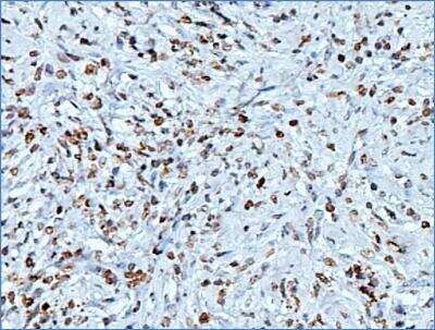 Histone H3 was detected in formalin fixed paraffin-embedded sections of human breast cancer using Anti-Human Histone H3 Monoclonal Antibody (Catalog # NBP2-36468) at 1:200 overnight at 4C. The staining was developed using an HRP labeled secondary antibody and DAB reagent, and nuclei of cells were counter-stained with hematoxylin.