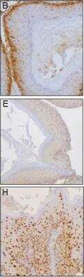 Analysis of human IKK alpha in tumors of the three groups B (C-IKK alpha), E (Control), H (N-IKK alpha). Specific staining of human IKK alpha-using the NB100-56704 antibody. Scale bar: 70um. Image collected and cropped by CiteAb from the following publication (//www.oncotarget.com/article/8792/text/) licensed under a CC-BY license.