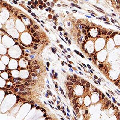 Analysis human colon cancer using 1:50 conc. of HDAC3 antibody on a Bond Rx autostainer (Leica Biosystems). The assay involved 20 minutes of heat induced antigen retrieval (HIER) using 10mM sodium citrate buffer (pH 6.0) and endogenous peroxidase quenching with peroxide block. The sections were incubated with primary antibody for 30 minutes and Bond Polymer Refine Detection (Leica Biosystems) with DAB was used for signal development followed by counterstaining with hematoxylin. Whole slide scanning and capturing of representative images was performed using Aperio AT2 (Leica Biosystems). Nuclear staining of HDAC3 was observed.