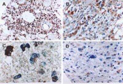 Formalin-fixed paraffin-embedded tissue sections of human gliomas stained for Active/Cleaved Caspase-6 expression using Caspase-6 antibody at 1:2000. Gemistocytoma (low grade tumor) at A) low and B) high magnification. Two examples of anaplastic, high grade (III) infiltrating gliomas (C and D). Increased active/cleaved Caspase-6 may be seen in high grade, compared to low grade tumors. Hematoxylin-eosin counterstain.