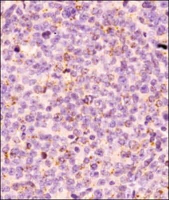IHC analysis of a formalin fixed and paraffin embedded tissue section of human endometrial cancer xenograft using Bim antibody (NBP2-53088) at 1:50 dilution. The signal was detected using HRP labeled secondary antibody and DAB staining method which followed counter-staining with hematoxylin. The antibody generated a specific cytoplasmic staining with punctate appearance, signifying Bim/Bcl2L11 presence on mitochondria.