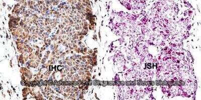 <b>Orthogonal Strategies Validation. </b>Dual RNAscope ISH-IHC: Survivin Antibody [NB500-201] - Formalin-fixed paraffin-embedded tissue sections of human esophagus squamous cell carcinoma were probed for Survivin mRNA (ACD RNAScope Probe, [465361]; Fast Red chromogen, ACD [322360]). Adjacent tissue section was processed for immunohistochemistry using rabbit polyclonal [NB500-201] at 1.5ug/mL with overnight incubation at 4 degrees Celsius followed by incubation with anti-rabbit IgG VisUCyte HRP Polymer Antibody [VC003] and DAB chromogen (yellow-brown). Tissue was counterstained with hematoxylin (blue). Specific staining was localized to tumor cells.