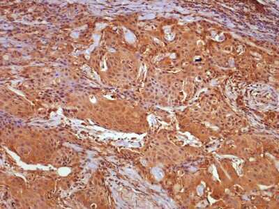 cIAP2 staining in Oral Squamous Cell Carcinoma (OSCC). 