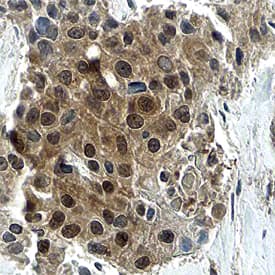Cyclin D3 was detected in immersion fixed paraffin-embedded sections of human breast cancer tissue using Human Cyclin D3 Monoclonal Antibody (Catalog # MAB6570) at 15 µg/mL overnight at 4 °C. Before incubation with the primary antibody, tissue was subjected to heat-induced epitope retrieval using Antigen Retrieval Reagent-Basic (Catalog # CTS013). Tissue was stained using the Anti-Mouse HRP-DAB Cell & Tissue Staining Kit (brown; Catalog # CTS002) and counterstained with hematoxylin (blue). Specific staining was localized to nuclei and cytoplasm. View our protocol for Chromogenic IHC Staining of Paraffin-embedded Tissue Sections.