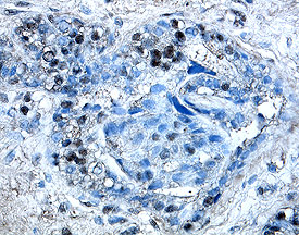Yes was detected in immersion fixed paraffin-embedded sections of human breast cancer tissue using 25 µg/mL Human/Mouse/Rat Yes Monoclonal Antibody (Catalog # MAB32051) overnight at 4 °C. Tissue was stained with the Anti-Mouse HRP-DAB Cell & Tissue Staining Kit (brown; Catalog # CTS002) and counterstained with hematoxylin (blue). View our protocol for Chromogenic IHC Staining of Paraffin-embedded Tissue Sections.