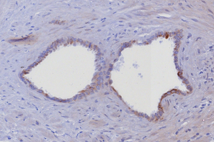 Formalin-fixed, paraffin-embedded human prostate stained with Cytokeratin 6 antibody (KRT6/8198R). HIER: Tris/EDTA, pH9.0, 45min. Secondary: HRP-polymer, 30min. DAB, 5min.