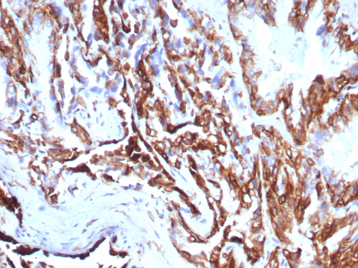 Formalin-fixed, paraffin-embedded human prostate carcinoma stained with Cytokeratin 7 antibody (rKRT7/8763). HIER: Tris/EDTA, pH9.0, 45min. Secondary: HRP-polymer, 30min. DAB, 5min.