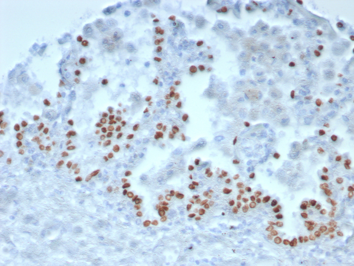 Formalin-fixed, paraffin-embedded human lung stained with TTF-1 / NKX2-1 antibody (TTF1/8143R). HIER: Tris/EDTA, pH9.0, 45min. Secondary: HRP-polymer, 30min. DAB, 5min.
