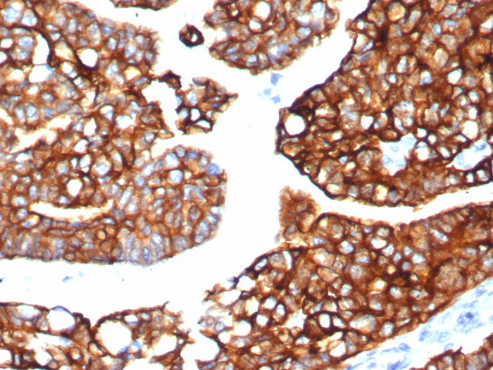 Formalin-fixed, paraffin-embedded human lung carcinoma stained with Cytokeratin 7 antibody (KRT7/8121R). HIER: Tris/EDTA, pH9.0, 45min. Secondary: HRP-polymer, 30min. DAB, 5min.