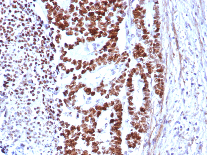 Formalin-fixed, paraffin-embedded human colon carcinoma stained with p53 antibody (rTP53/8579).