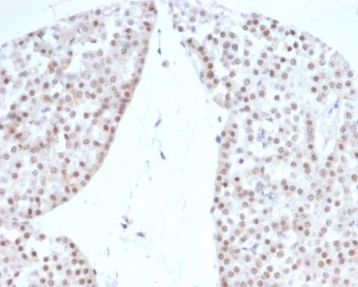 Formalin-fixed, paraffin-embedded human renal oncocytoma stained with SF-1/NR5A1/Steroidogenic Factor 1 antibody (rNR5A1/4369). HIER: Tris/EDTA, pH9.0, 45min. Secondary: HRP-polymer, 30min. DAB, 5min.