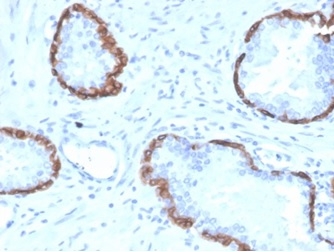 Formalin-fixed, paraffin-embedded human prostate stained with Cytokeratin 14 antibody (KRT14/4128). HIER: Tris/EDTA, pH9.0, 45min. Secondary: HRP-polymer, 30min. DAB, 5min.