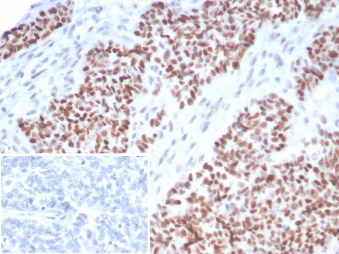 Formalin-fixed, paraffin-embedded human ovarian carcinoma stained with p53 antibody (TP53/7082R). Inset: PBS instead of primary antibody; secondary only negative control.