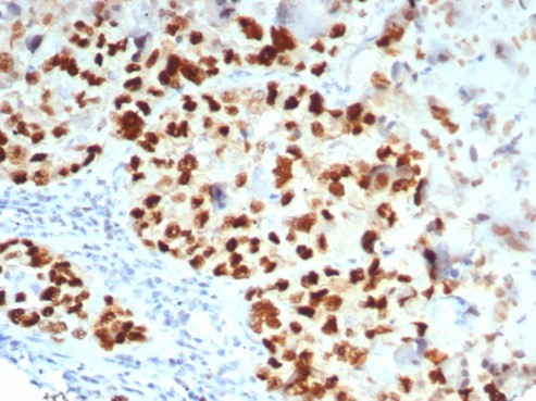 Formalin-fixed, paraffin-embedded human lung carcinoma stained with GATA-3 antibody (GATA3/7685R). HIER: Tris/EDTA, pH9.0, 45min. Secondary: HRP-polymer, 30min. DAB, 5min.