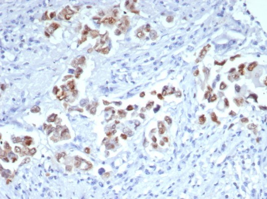 Formalin-fixed, paraffin-embedded human breast carcinoma stained with GATA-3 antibody (GATA3/7685R). HIER: Tris/EDTA, pH9.0, 45min. Secondary: HRP-polymer, 30min. DAB, 5min