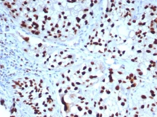 Formalin-fixed, paraffin-embedded human bladder stained with GATA-3 antibody (GATA3/7685R). HIER: Tris/EDTA, pH9.0, 45min. Secondary: HRP-polymer, 30min. DAB, 5min.